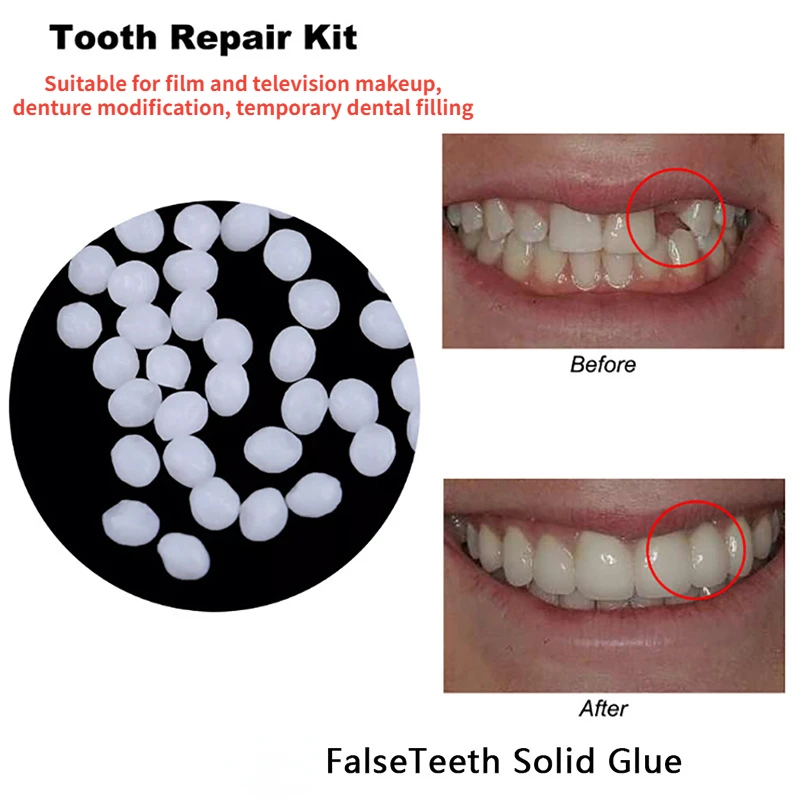 Teeth Whitening At Home - Colle de réparation dentaire façonnable, lacunes