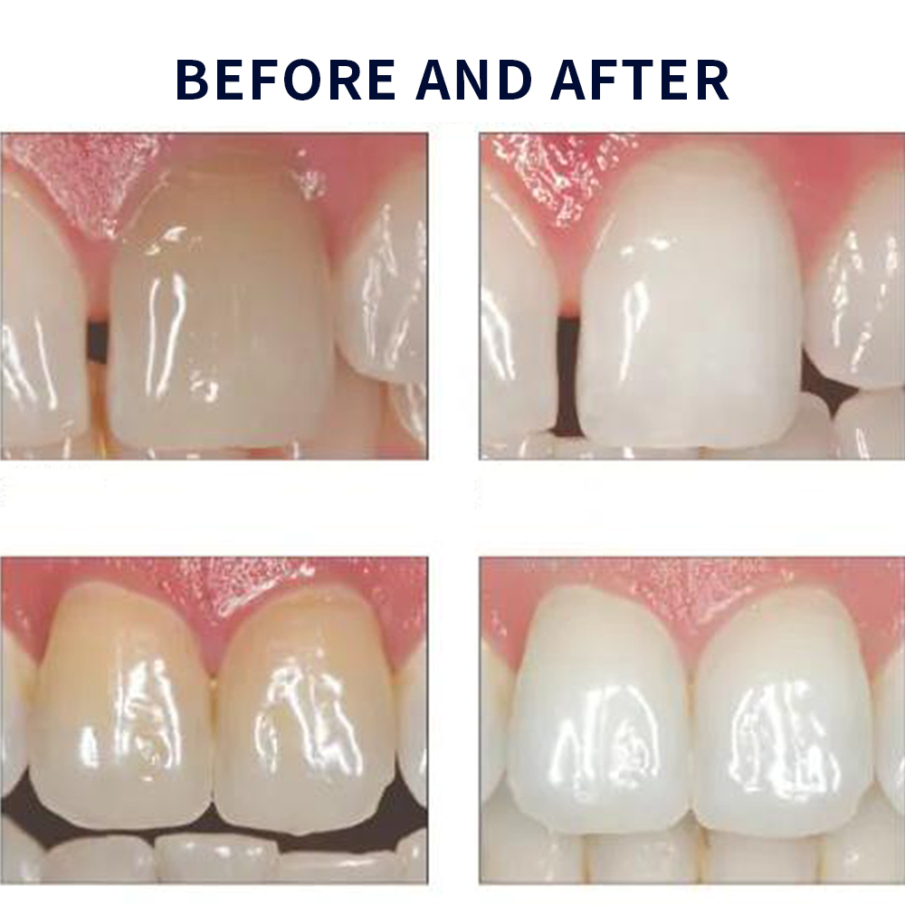 Opalwisdom-Kit de Blanchiment  - Teeth Whitening Hismile avis et prix