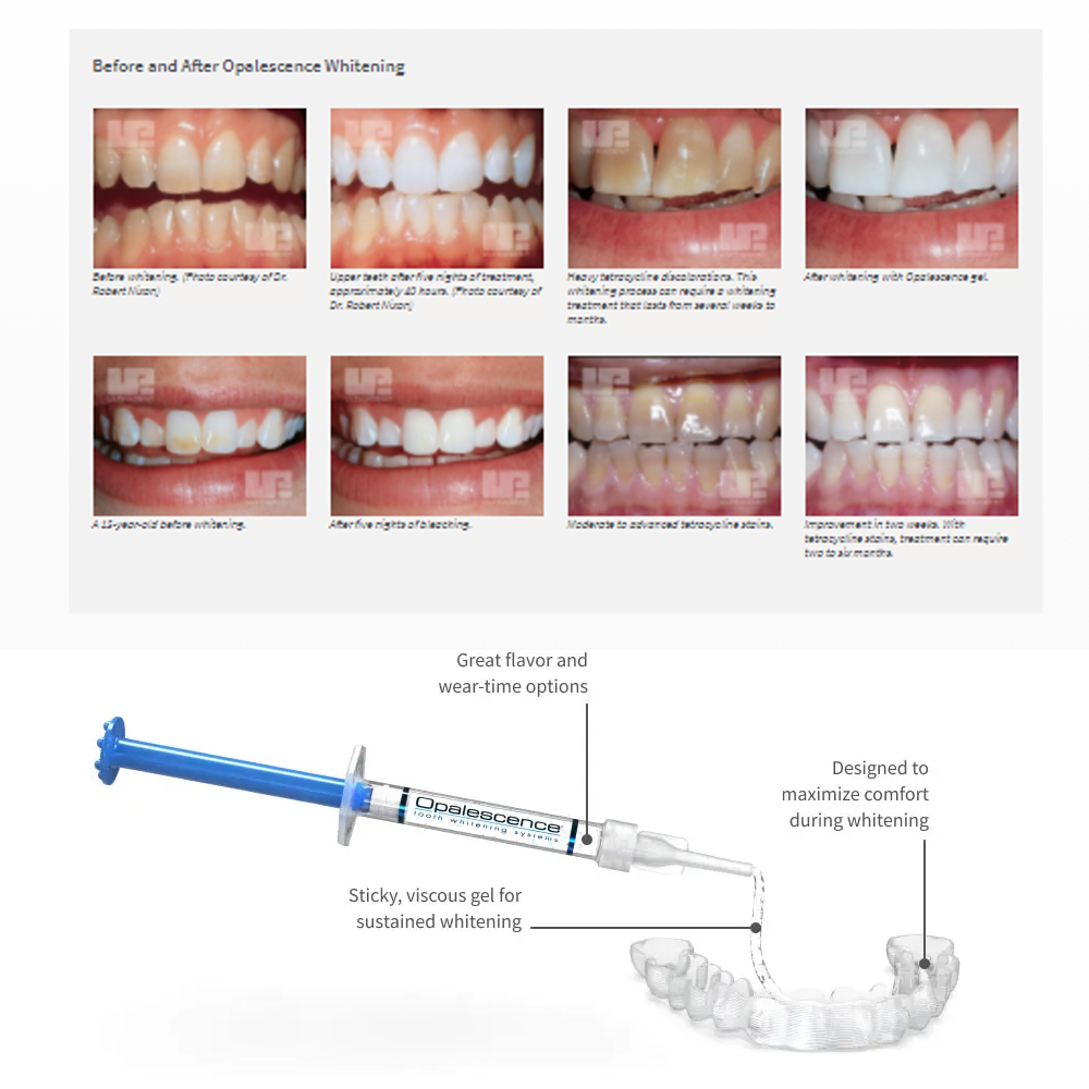 Opalwisdom-Kit de Blanchiment  - Teeth Whitening Hismile avis et prix