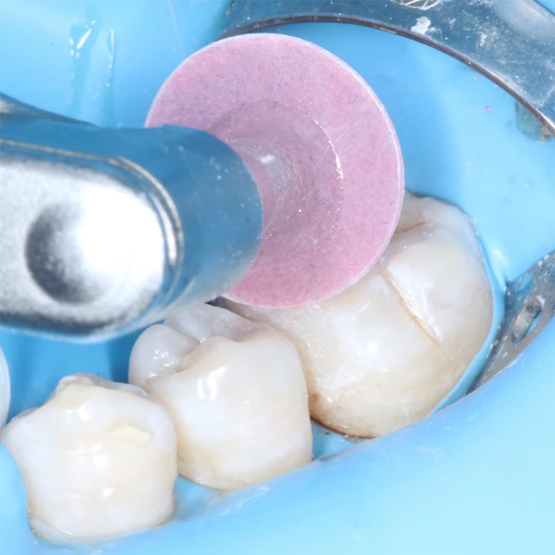 40 disques de polissage dentai - Teeth Whitening Uk avis et prix