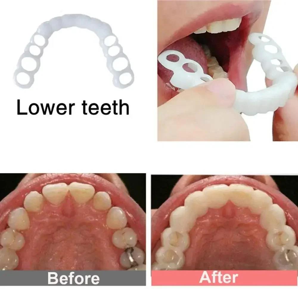 Nouvelles Facettes Dentaires E - Teeth Whitening For Photos avis et prix