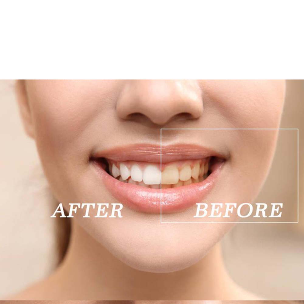 Kit de Gel de blanchiment des  - Teeth Whitening Bleaching Kit avis et prix