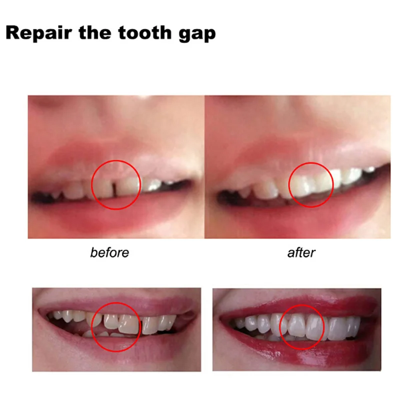 Colle de réparation dentaire f - Teeth Whitening At Home avis et prix