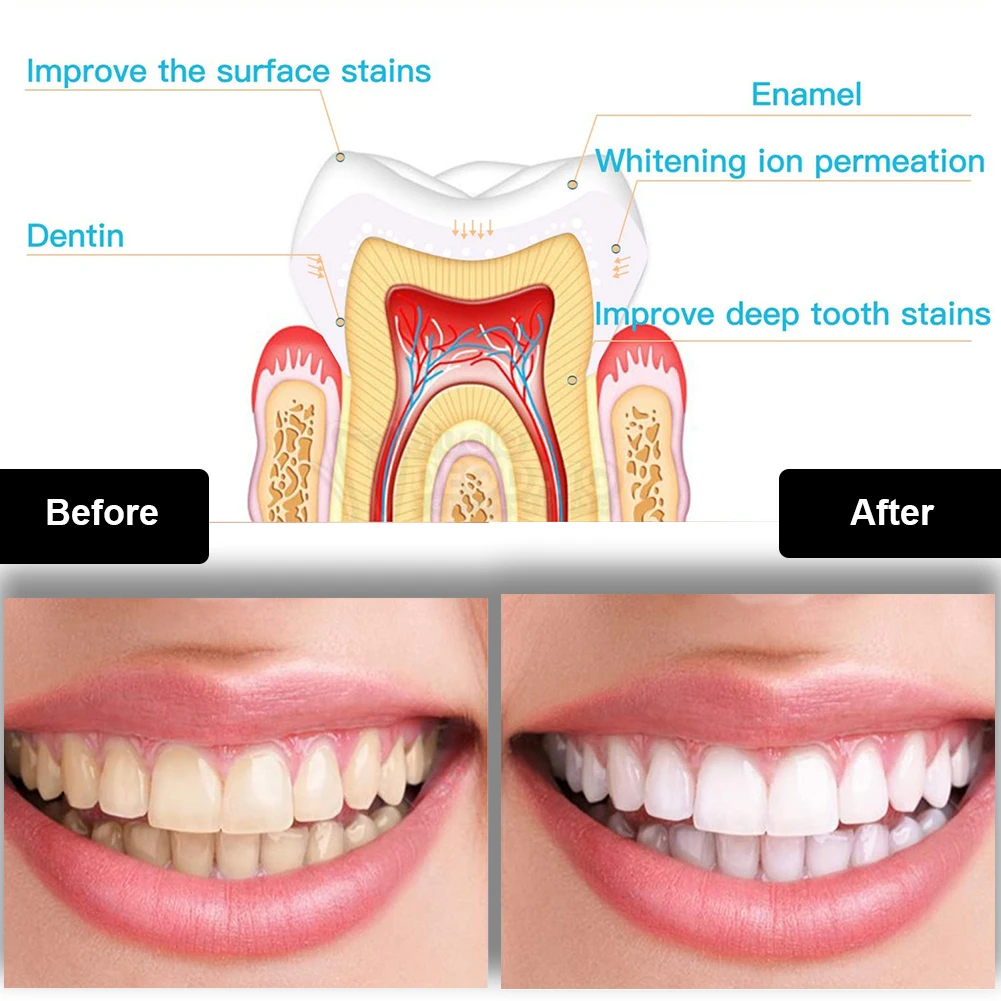 Kit de blanchiment des dents d - Teeth Whitening With Blue Light avis et prix