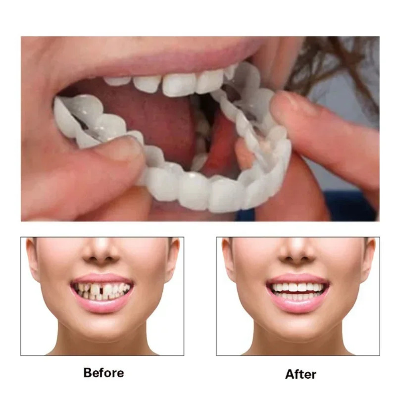 Nouvelles Facettes Dentaires R - Teeth Whitening For Photos avis et prix